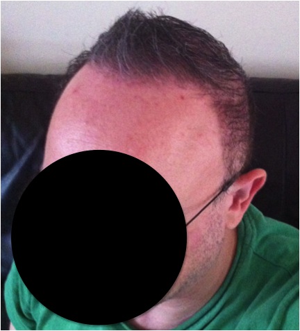 http://www.dermhairclinic.com/wp-content/uploads/2013/02/beard-hair-transplant-3.jpg