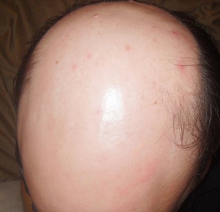 http://www.dermhairclinic.com/wp-content/uploads/2013/02/beard-hair-transplant-4.jpg