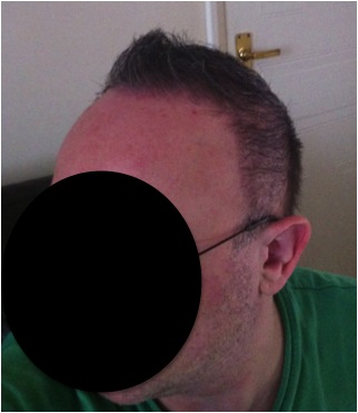 http://www.dermhairclinic.com/wp-content/uploads/2013/02/beard-hair-transplant-5.jpg