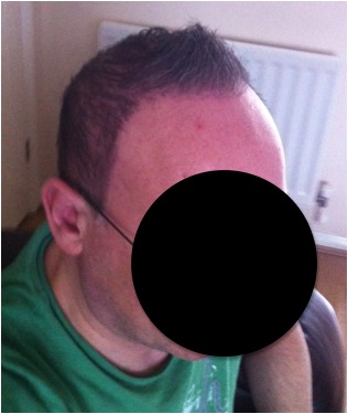 http://www.dermhairclinic.com/wp-content/uploads/2013/02/beard-hair-transplant-6.jpg