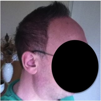 http://www.dermhairclinic.com/wp-content/uploads/2013/02/beard-hair-transplant-7.jpg