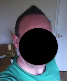 http://www.dermhairclinic.com/wp-content/uploads/2013/02/beard-hair-transplant-8.jpg