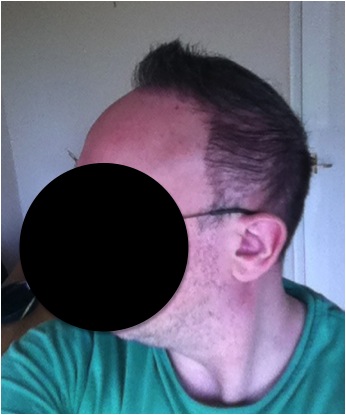 http://www.dermhairclinic.com/wp-content/uploads/2013/02/beard-hair-transplant-9.jpg