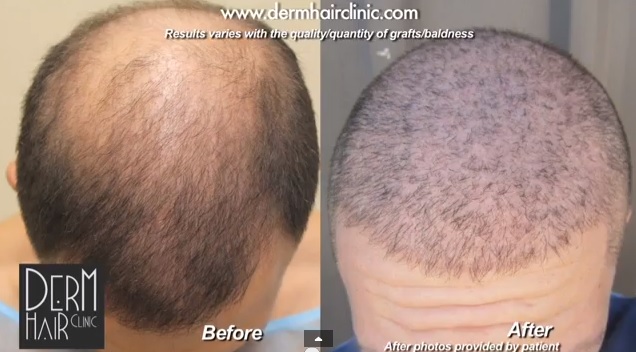 body-hair-transplant-0555.jpg