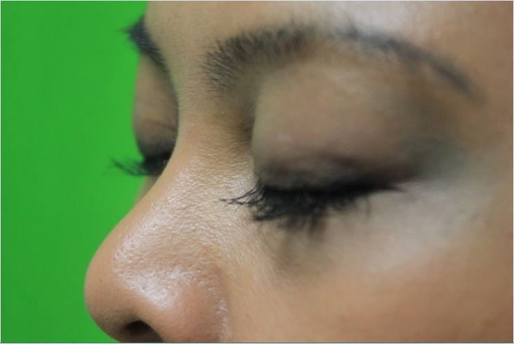 http://www.dermhairclinic.com/wp-content/uploads/2013/07/eyelash-hair-transplant-0341.jpg