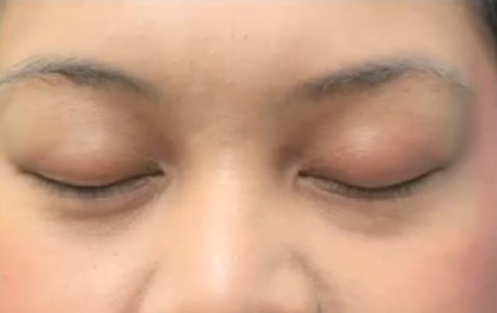 eyelash-hair-transplant-085611.jpg