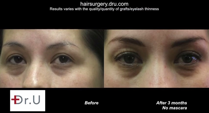 Eyelash hair Transplant Surgery| Nape Donor Hair Grafts