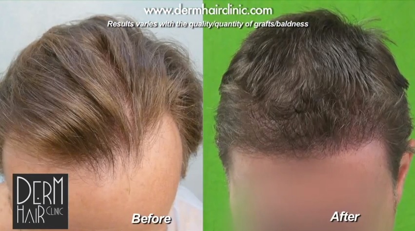 receding hairline before and after