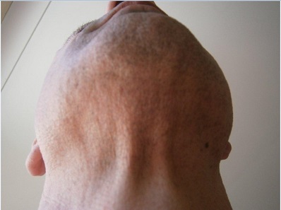 body-hair-transplant-0411.jpg