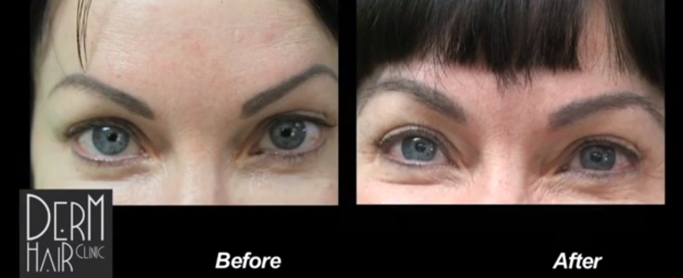 Los Angeles UGraft eyebrow hair transplant achieves great results after failed tattoos