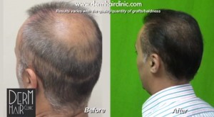 FUE-hair-restoration-04561-300x165.jpg