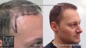 http://www.dermhairclinic.com/wp-content/uploads/2013/11/FUE-hair-restoration-034123-300x167.jpg