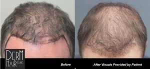 http://www.dermhairclinic.com/wp-content/uploads/2013/11/FUE-hair-restoration-044351-300x139.jpg
