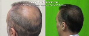 http://www.dermhairclinic.com/wp-content/uploads/2013/12/body-hair-transplant-03219-300x124.jpg