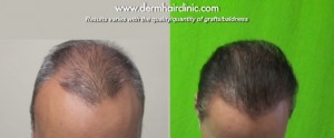 http://www.dermhairclinic.com/wp-content/uploads/2013/12/body-hair-transplant-03443-300x124.jpg