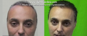 http://www.dermhairclinic.com/wp-content/uploads/2013/12/body-hair-transplant-04341-300x125.jpg