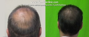 http://www.dermhairclinic.com/wp-content/uploads/2013/12/body-hair-transplant-05782-300x125.jpg
