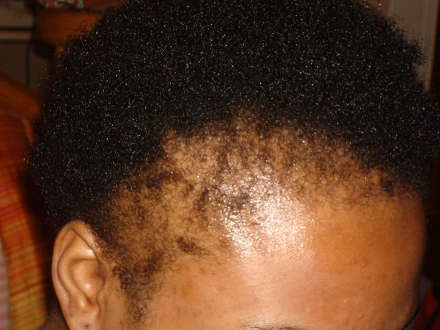Causes Of Hair Loss In African American Women: Traction Alopecia and Hair Care For Black Women