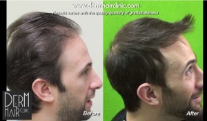 http://www.dermhairclinic.com/wp-content/uploads/2014/01/celebrity-hair-transplant-03424-300x176.jpg