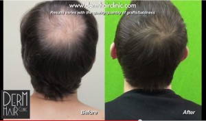 celebrity-hair-transplant-0342444-300x177.jpg