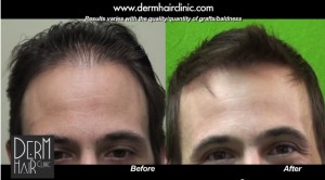 http://www.dermhairclinic.com/wp-content/uploads/2014/01/celebrity-hair-transplant-234123-300x166.jpg