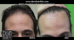 http://www.dermhairclinic.com/wp-content/uploads/2014/01/celebrity-hair-transplant-34242-300x163.jpg