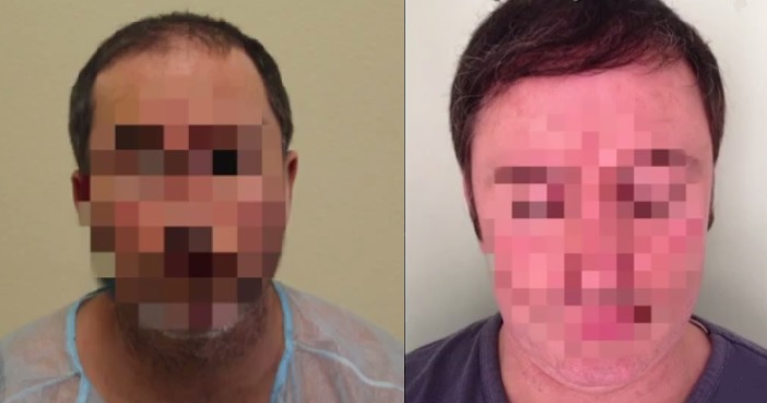 body-hair-transplant-3423411.jpg