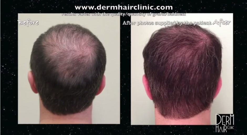 http://www.dermhairclinic.com/wp-content/uploads/2014/02/body-hair-transplant-342342332.jpg