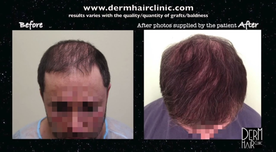 http://www.dermhairclinic.com/wp-content/uploads/2014/02/body-hair-transplant-4534.jpg