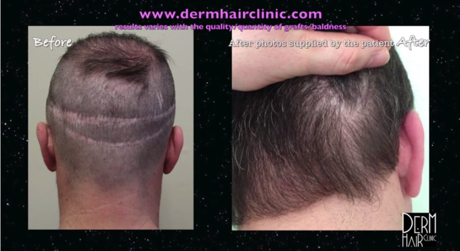http://www.dermhairclinic.com/wp-content/uploads/2014/02/body-hair-transplant-45345.jpg