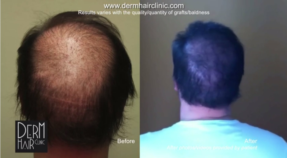 http://www.dermhairclinic.com/wp-content/uploads/2014/03/body-hair-transplant-0342424.jpg