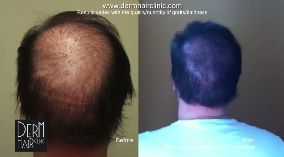 body-hair-transplant-0342424.jpg