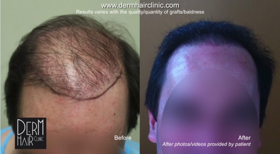 body-hair-transplant-043244.jpg