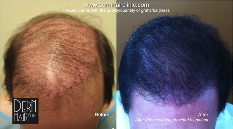 http://www.dermhairclinic.com/wp-content/uploads/2014/03/body-hair-transplant-342424.jpg