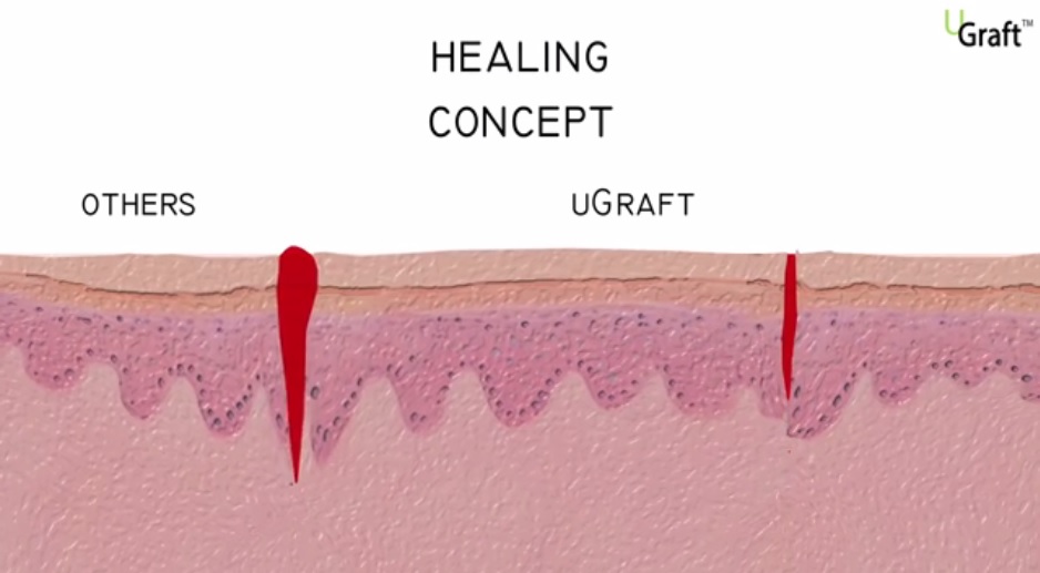 The top portion of an inverted wound edge (UGraft - UPunch Rotor wounds) would close ahead of that of an everted wound edge (Other FUE Punches), resulting in a better cosmetic outcome. 
