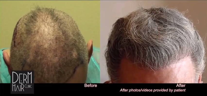 http://www.dermhairclinic.com/wp-content/uploads/2014/04/facial-hair-to-head-transplant-02323.jpg