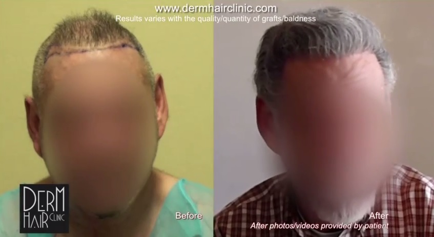 http://www.dermhairclinic.com/wp-content/uploads/2014/04/facial-hair-to-head-transplant-0332343.jpg