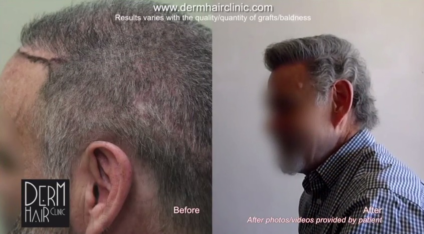 http://www.dermhairclinic.com/wp-content/uploads/2014/04/facial-hair-to-head-transplant-0356222.jpg