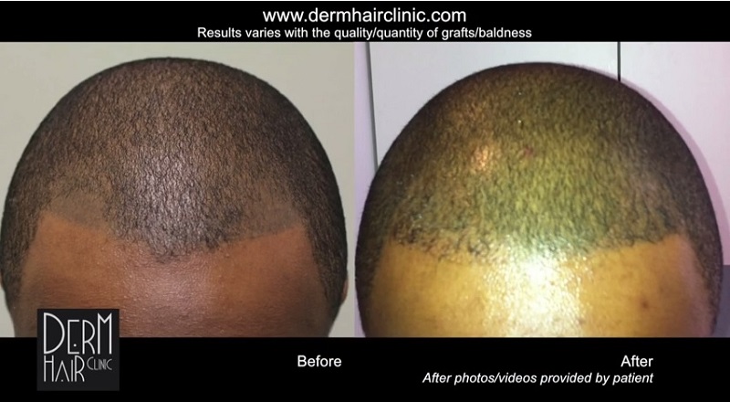 FUE-hair-transplant-067341.jpg