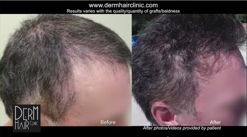 http://www.dermhairclinic.com/wp-content/uploads/2014/06/body-hair-transplant-0456.jpg