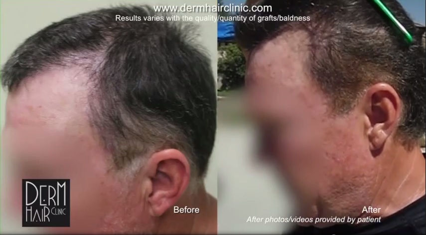 http://www.dermhairclinic.com/wp-content/uploads/2014/06/body-hair-transplant-045611.jpg