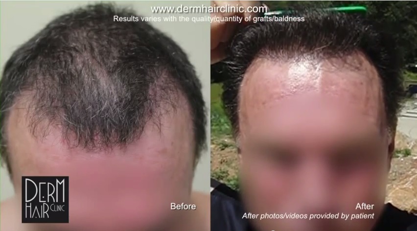 http://www.dermhairclinic.com/wp-content/uploads/2014/06/body-hair-transplant-056.jpg