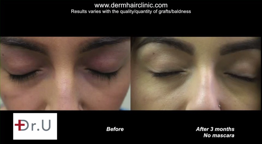 http://www.dermhairclinic.com/wp-content/uploads/2014/07/eyelash-hair-transplant-03493244.jpg 