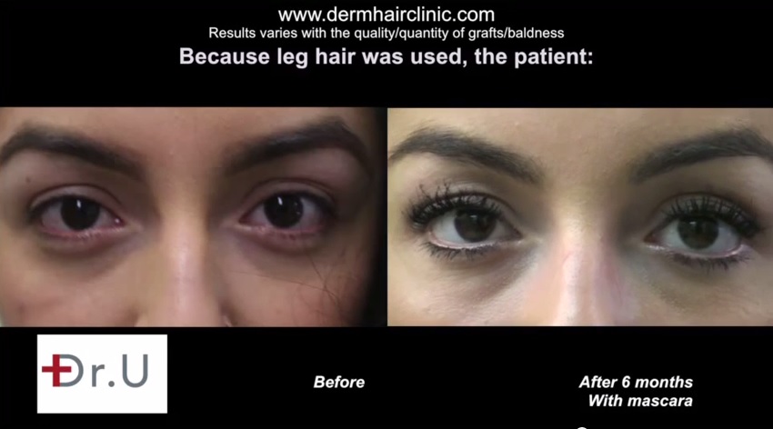http://www.dermhairclinic.com/wp-content/uploads/2014/07/eyelash-hair-transplant-0777.jpg 