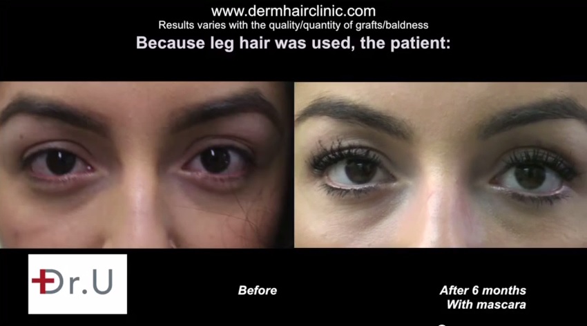 eyelash-hair-transplant-0777