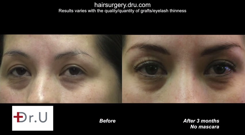 eyelash-transplant-0342353.jpg