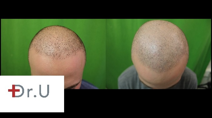 SMP via trichopigmentation| Frontal Scalp on Patient Before and After Treatment Series