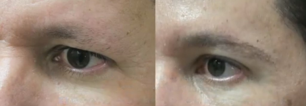 versatility of types of grafts extracted by UGraft FUE hair transplant in los angeles allows for use of leg hair in the creation of most natural looking eyebrows in this patient versatility of types of grafts extracted by UGraft FUE hair transplant in los angeles allows for use of leg hair in the creation of most natural looking eyebrows in this patient- Left Side View