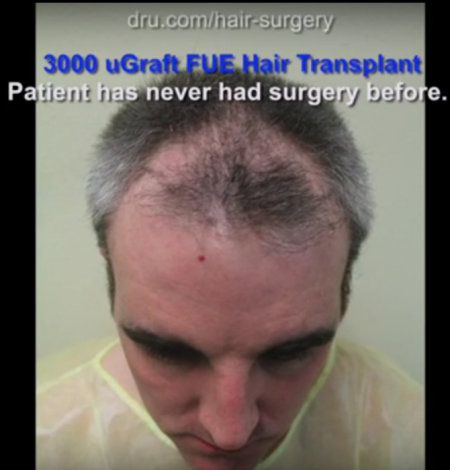 Young patient before hair restoration surgery by Dr U
