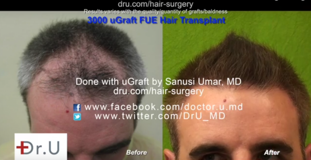 Los Angeles UGraft advanced follicular unit extraction using 3000 head hair donor grafts only - frontal scalp view before and after